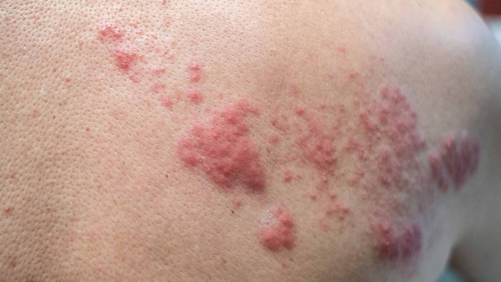 treatlocal-shingles-pagebody-1-1920x1080-1-1